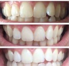 Teeth Before After AP24 toothpaste