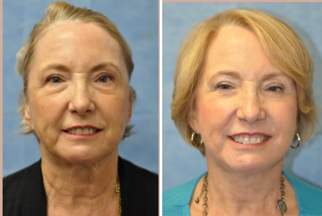 endoscopic facelift