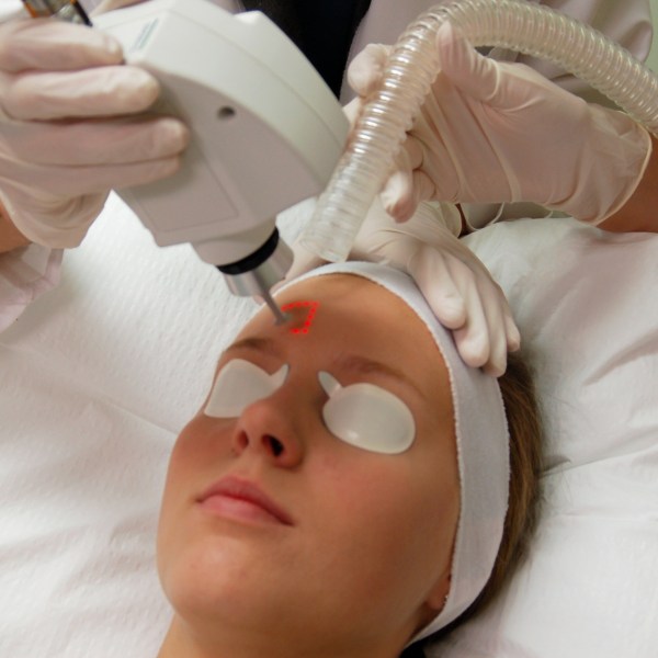 Laser skin treatment