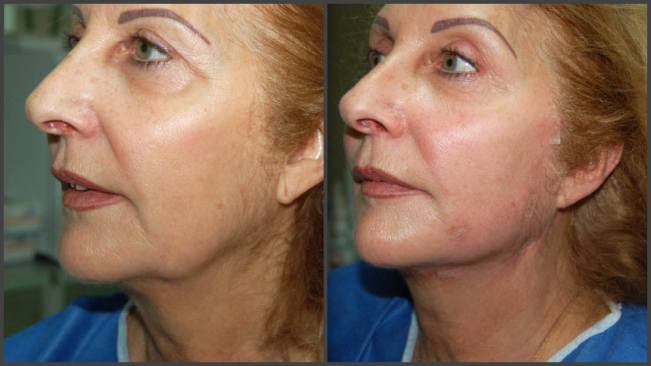 thread facelift